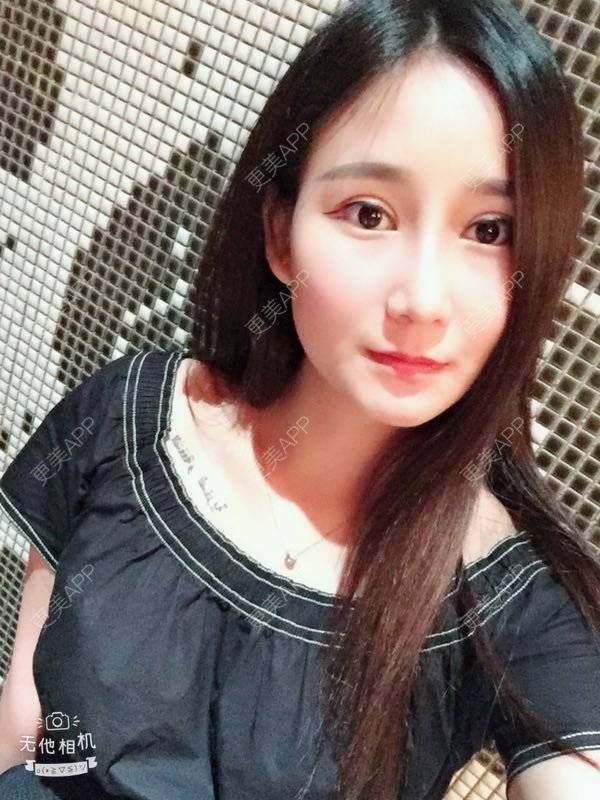 更美 - 一抹花色的双眼皮经验 | 双眼皮 | 重庆