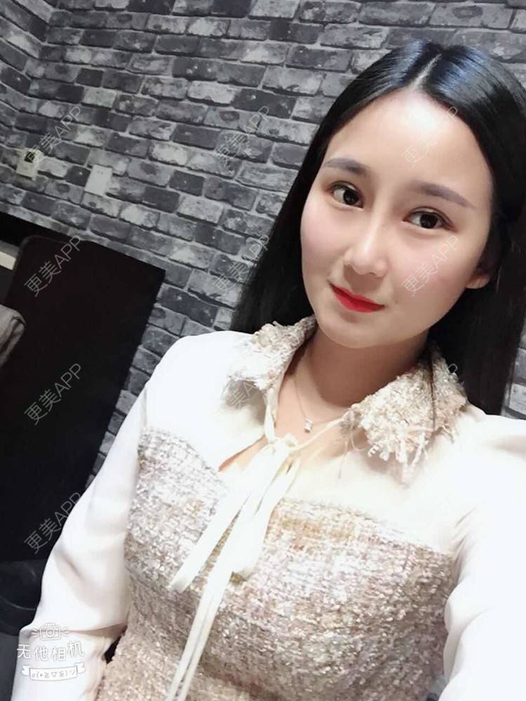更美 - 一抹花色的双眼皮经验 | 双眼皮 | 重庆
