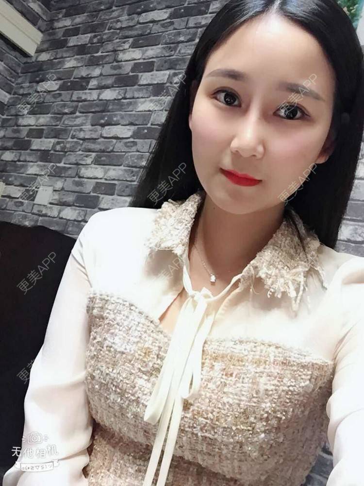 更美 - 一抹花色的双眼皮经验 | 双眼皮 | 重庆