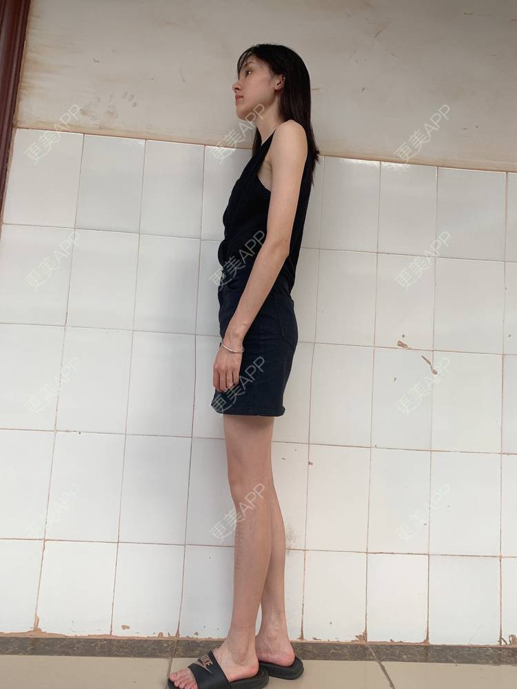 更美 - 更美用户n3lnMGS5KD的经验 | 手术淡疤 | 激光淡疤 | 综合淡疤 | 成都