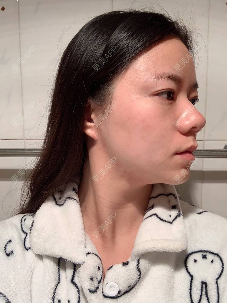 更美 - 更美用户pkMawECeYz的颈部经验 | 热玛吉 | 超声提升 | 除皱 | 颈部 | 除皱套餐