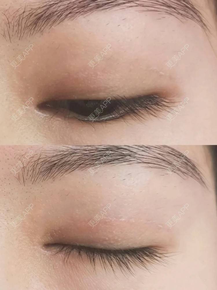 更美 - 更美用户nP6y0yD0GW的全切双眼皮经验 | 全切双眼皮 | 杭州