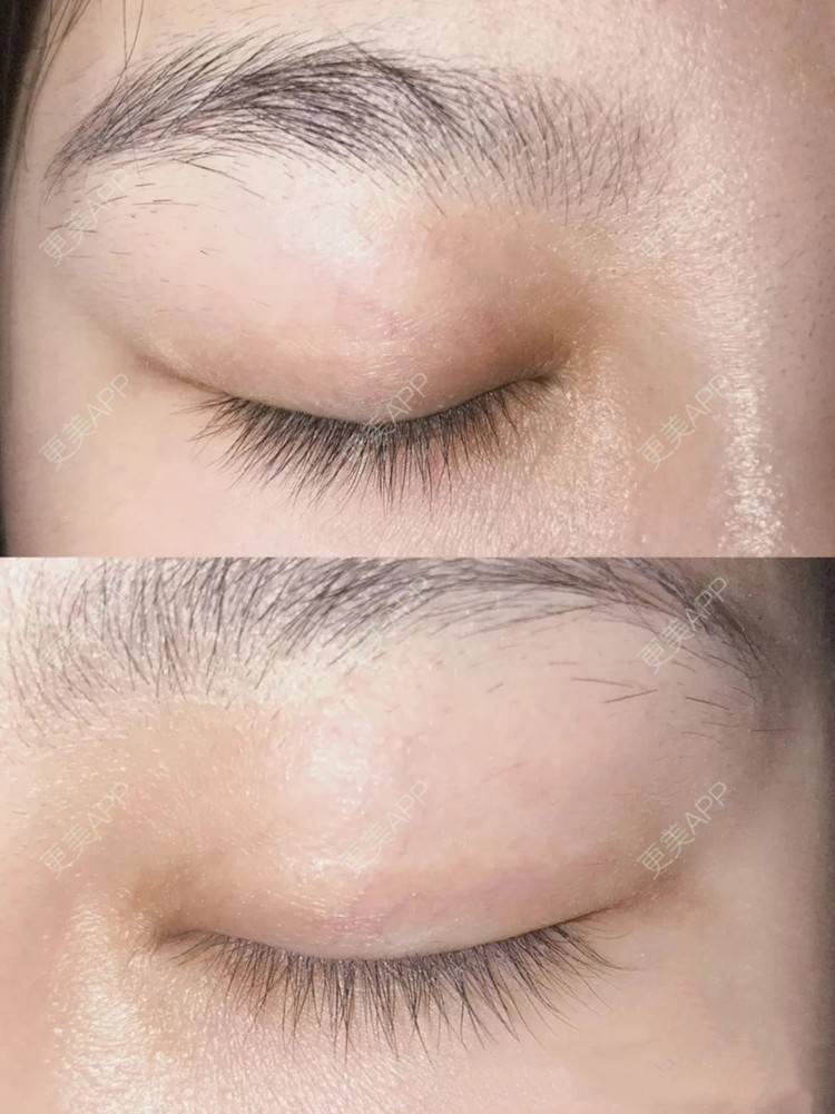 更美 - 更美用户nP6y0yD0GW的全切双眼皮经验 | 全切双眼皮 | 杭州