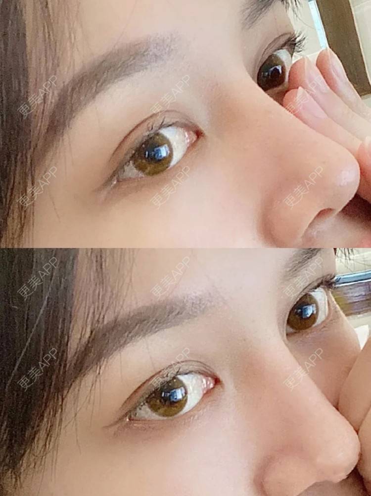 更美 - 更美用户nP6y0yD0GW的全切双眼皮经验 | 全切双眼皮 | 杭州