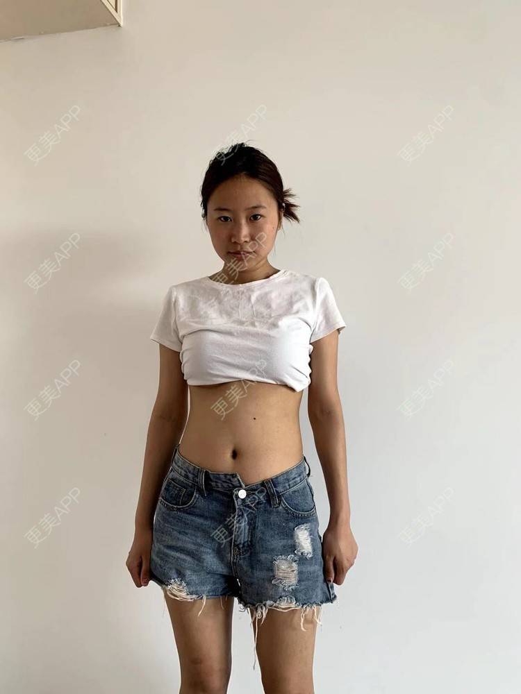 更美 - 更美用户4vKb9eTt9x的射频溶脂瘦腰部经验 | 射频溶脂瘦腰部 | 射频溶脂瘦腹部