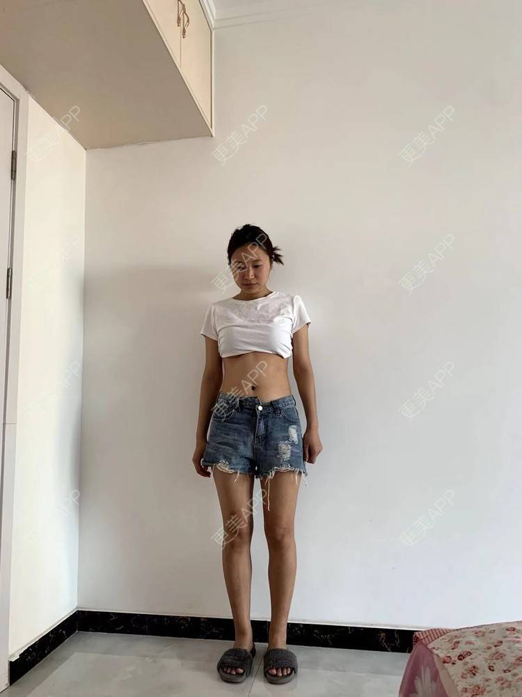 更美 - 更美用户4vKb9eTt9x的射频溶脂瘦腰部经验 | 射频溶脂瘦腰部 | 射频溶脂瘦腹部
