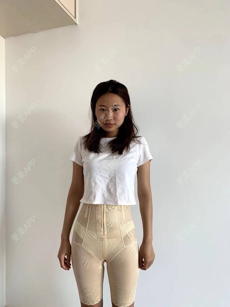 更美 - 更美用户4vKb9eTt9x的射频溶脂瘦腰部经验 | 射频溶脂瘦腰部 | 射频溶脂瘦腹部