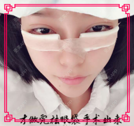 更美 - 迎颩菈屎卟艜紙茄的外切去眼袋经验 | 北京 | 外切去眼袋