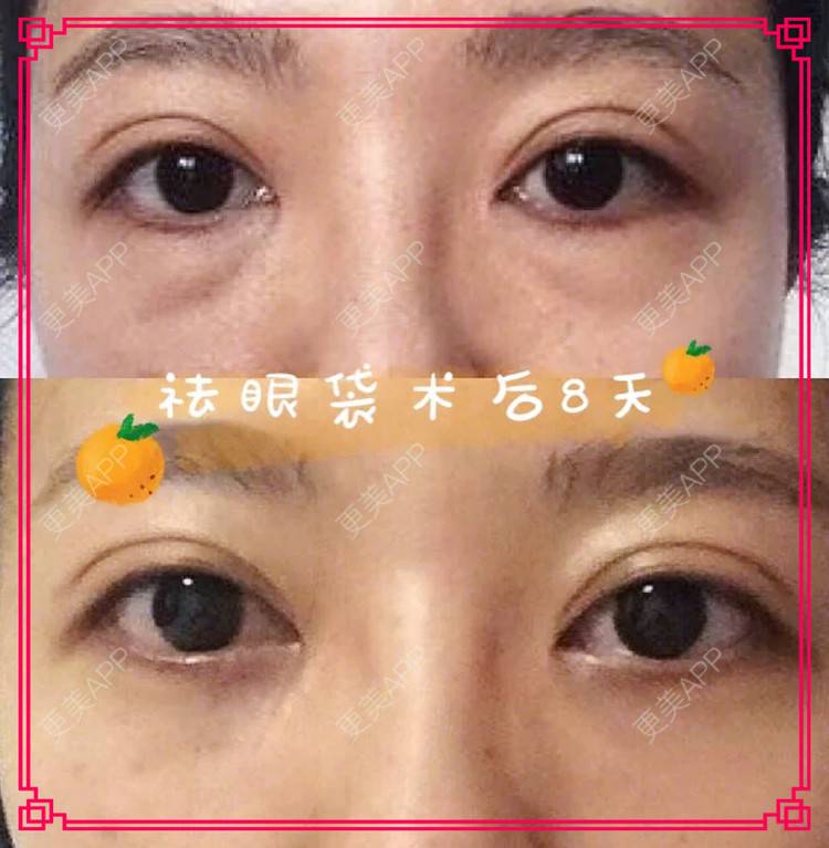 更美 - 迎颩菈屎卟艜紙茄的外切去眼袋经验 | 北京 | 外切去眼袋