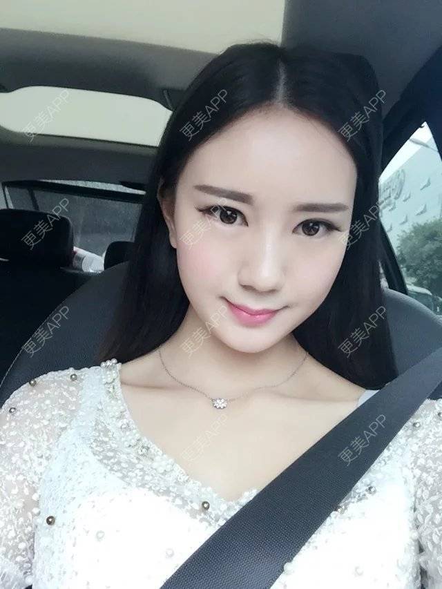 更美 - 玛丽莲.梦.露~的颧骨颧弓经验 | 颧骨颧弓 | 缩下巴 | 下颌角 | 成都 | 轮廓套餐