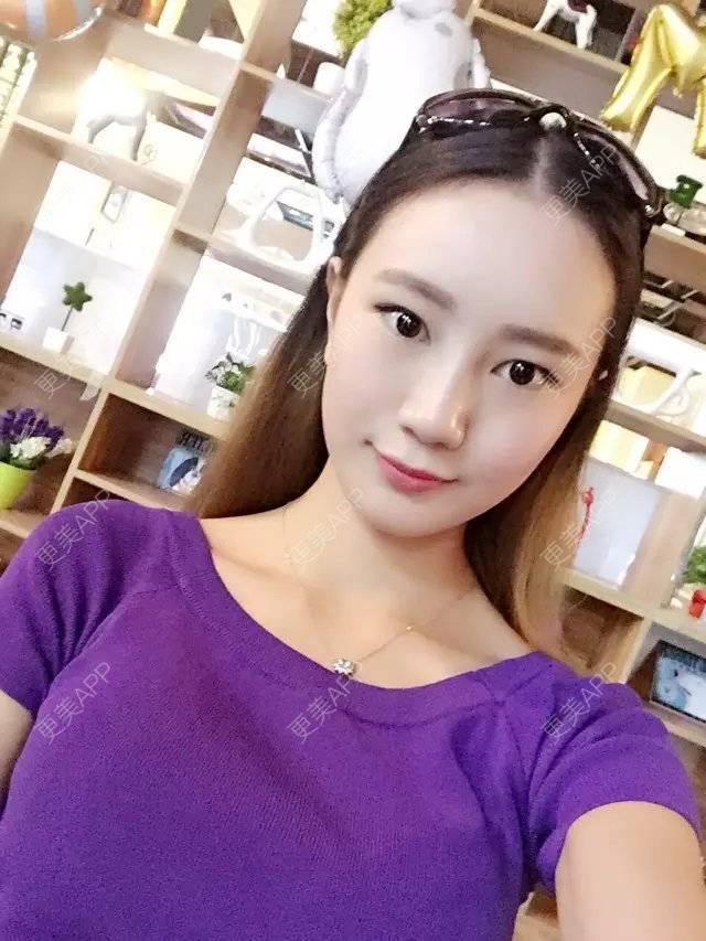 更美 - 玛丽莲.梦.露~的颧骨颧弓经验 | 颧骨颧弓 | 缩下巴 | 下颌角 | 成都 | 轮廓套餐