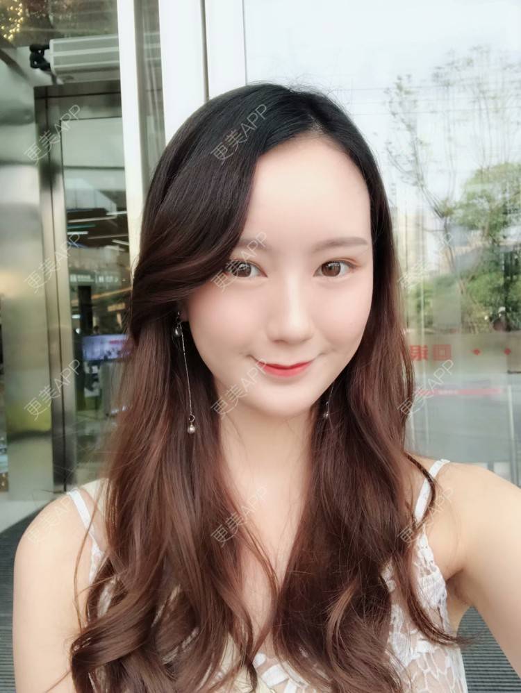 更美 - 玛丽莲.梦.露~的颧骨颧弓经验 | 颧骨颧弓 | 缩下巴 | 下颌角 | 成都 | 轮廓套餐