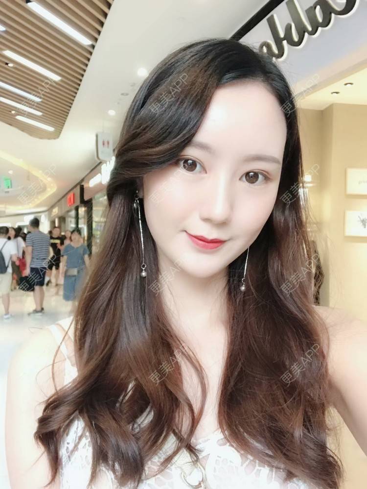 更美 - 玛丽莲.梦.露~的颧骨颧弓经验 | 颧骨颧弓 | 缩下巴 | 下颌角 | 成都 | 轮廓套餐