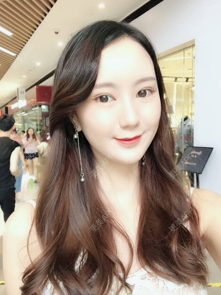 更美 - 玛丽莲.梦.露~的颧骨颧弓经验 | 颧骨颧弓 | 缩下巴 | 下颌角 | 成都 | 轮廓套餐