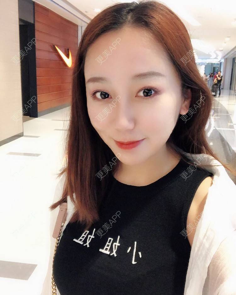 更美 - 更美用户piaDPAvn90的玻尿酸经验 | 玻尿酸全面部 | 玻尿酸眉弓 | 玻尿酸 | 深圳