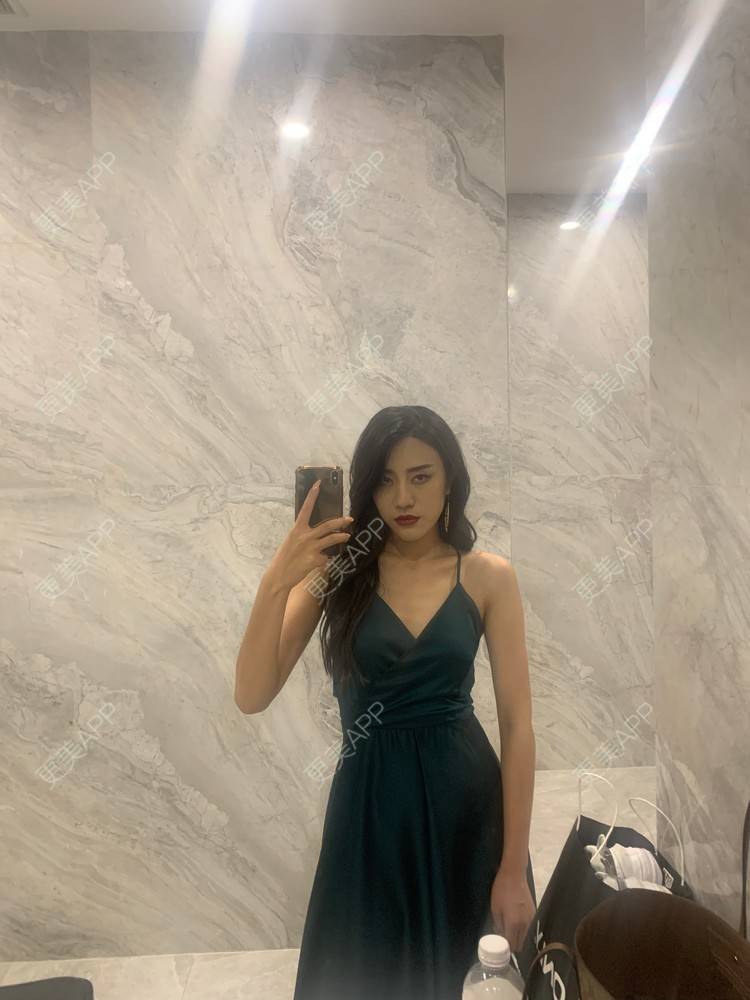 更美 - 不需要理由1的颧骨内推经验 | 颧骨内推 | 成都 | 颧弓降低 | 全脸整形套餐 | V脸套餐 | 下颌角切除