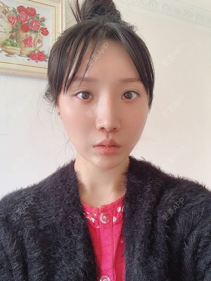 更美 - 更美用户DLi7HL09O1的人中缩短经验 | 广州 | 人中缩短