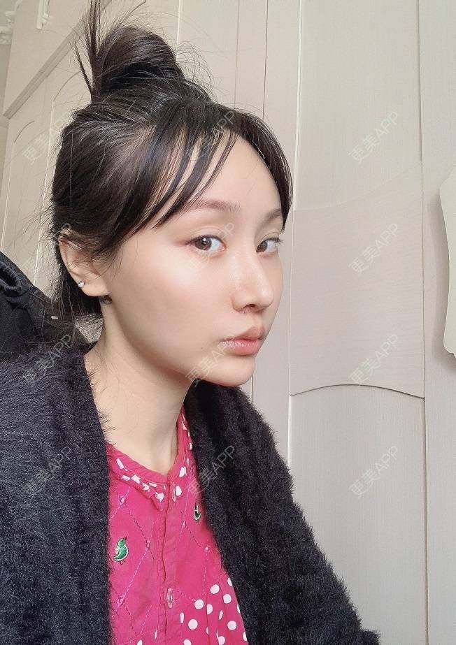 更美 - 更美用户DLi7HL09O1的人中缩短经验 | 广州 | 人中缩短