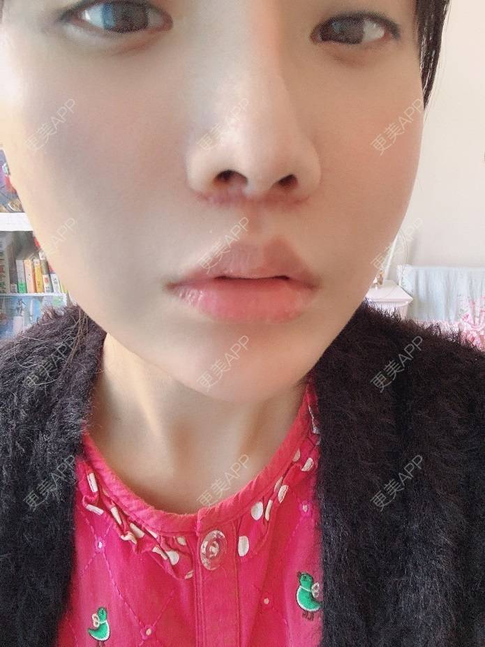 更美 - 更美用户DLi7HL09O1的人中缩短经验 | 广州 | 人中缩短