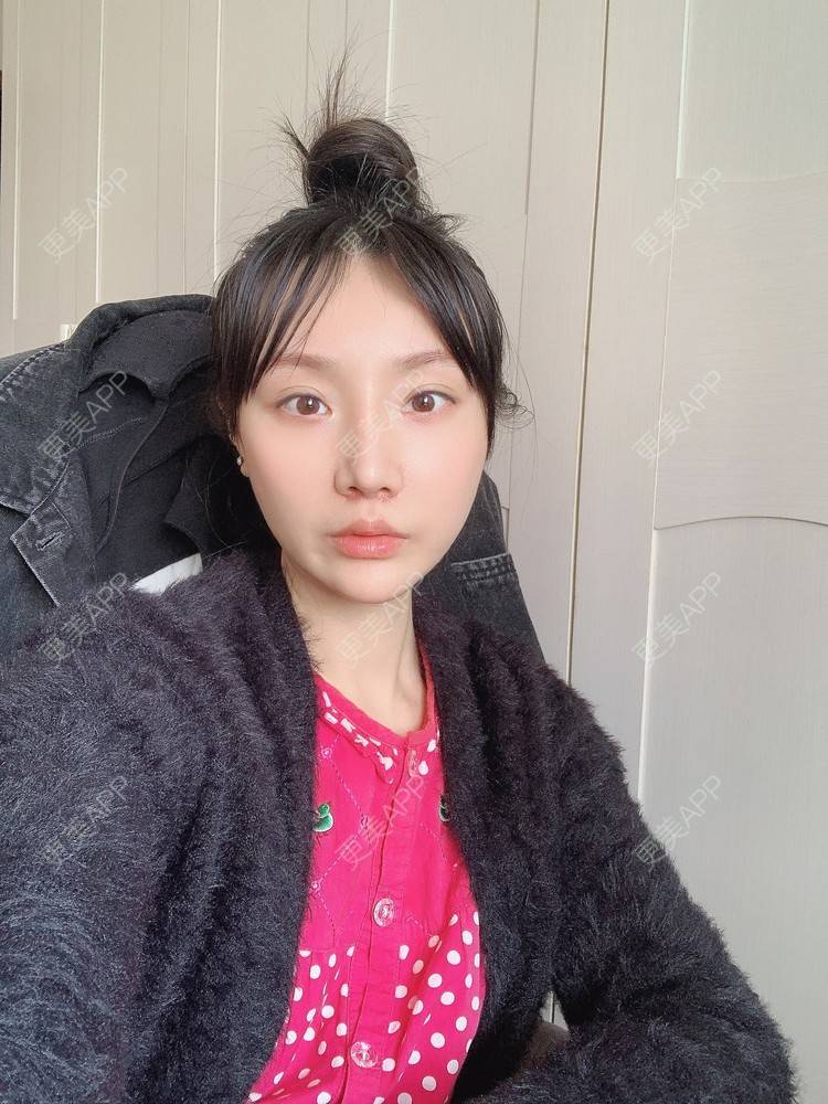 更美 - 更美用户DLi7HL09O1的人中缩短经验 | 广州 | 人中缩短