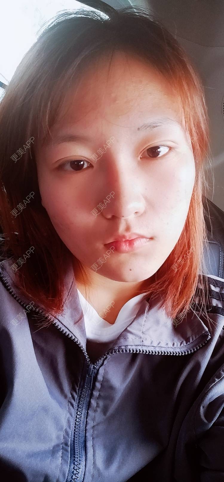 更美 - 更美用户tbs28rKiLZ的玻尿酸卧蚕经验 | 玻尿酸卧蚕 | 杭州