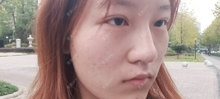 更美 - 更美用户tbs28rKiLZ的玻尿酸卧蚕经验 | 玻尿酸卧蚕 | 杭州