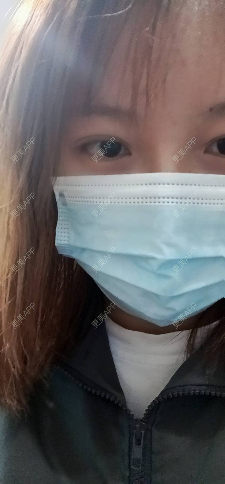 更美 - 更美用户tbs28rKiLZ的玻尿酸卧蚕经验 | 玻尿酸卧蚕 | 杭州