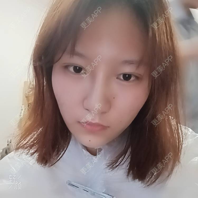 更美 - 更美用户tbs28rKiLZ的玻尿酸卧蚕经验 | 玻尿酸卧蚕 | 杭州
