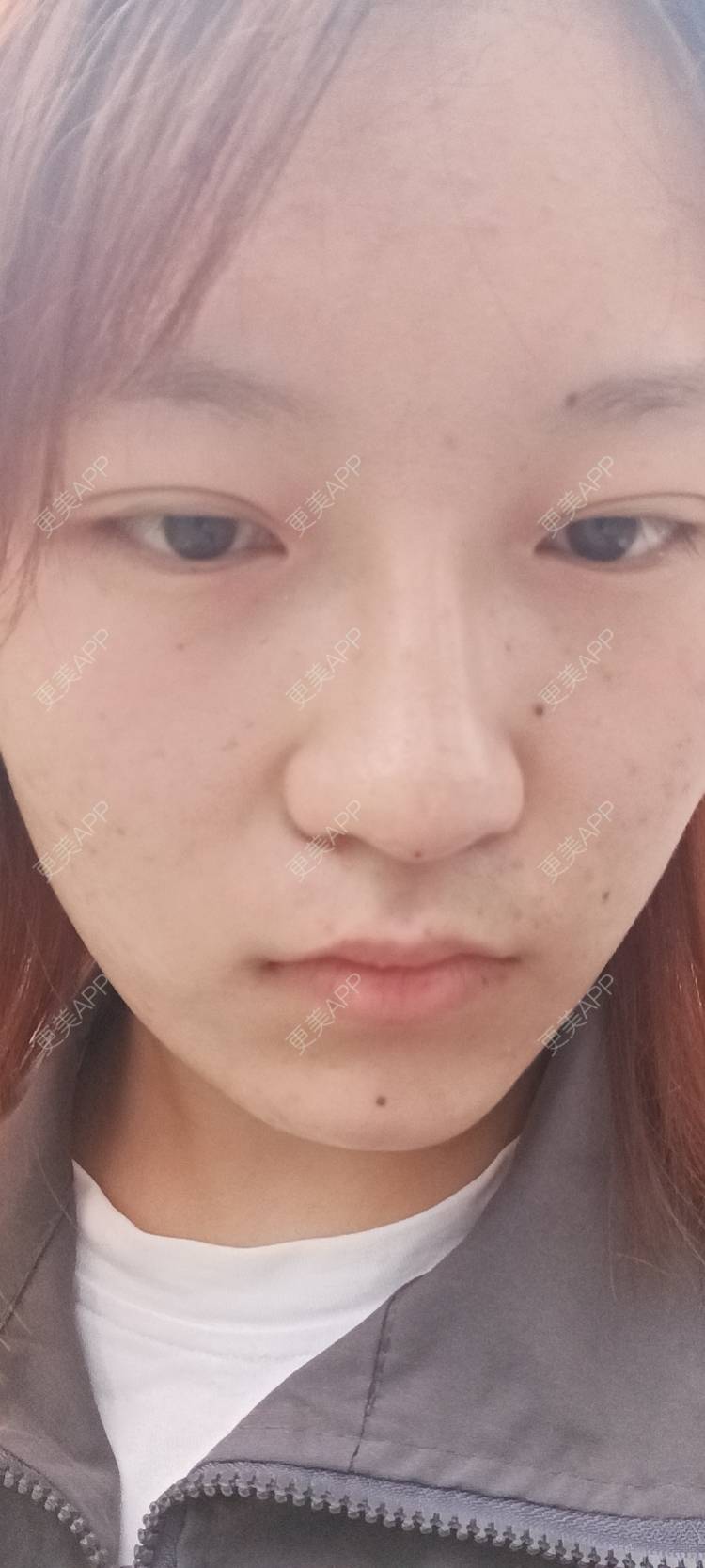 更美 - 更美用户tbs28rKiLZ的玻尿酸卧蚕经验 | 玻尿酸卧蚕 | 杭州