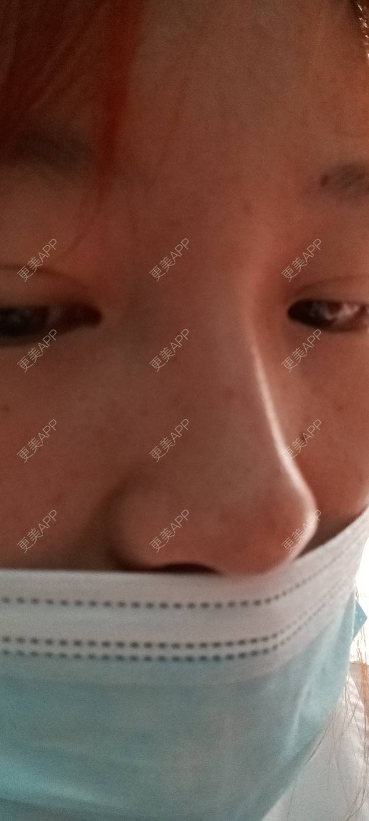 更美 - 更美用户tbs28rKiLZ的玻尿酸卧蚕经验 | 玻尿酸卧蚕 | 杭州