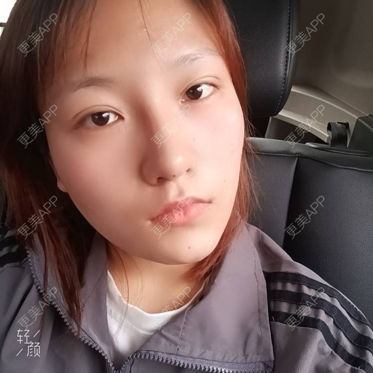 更美 - 更美用户tbs28rKiLZ的玻尿酸卧蚕经验 | 玻尿酸卧蚕 | 杭州