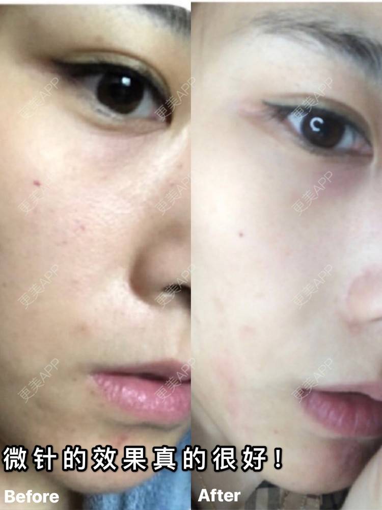 更美 - 麦可星-喵的微针水光经验 | 微针水光 | 大连