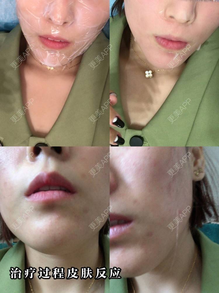 更美 - 麦可星-喵的微针水光经验 | 微针水光 | 大连