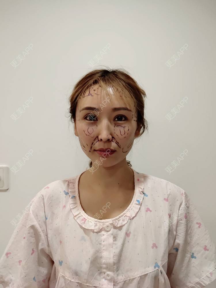 更美 - 更美用户TQtXAB9i5m的自体脂肪丰苹果肌经验 | 自体脂肪填充法令纹 | 自体脂肪丰苹果肌 | 自体脂肪全面部填充