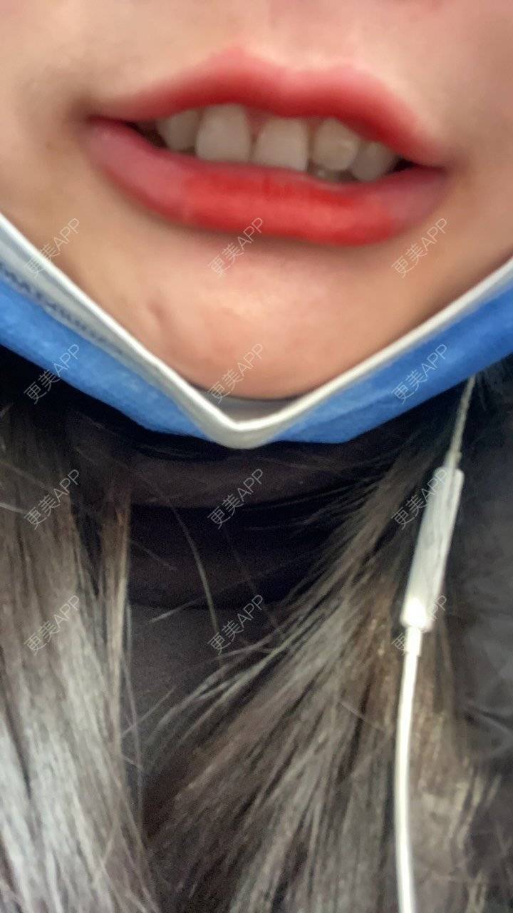 更美 - 更美的小沁沁的皓齿美白经验 | 皓齿美白 | 郑州