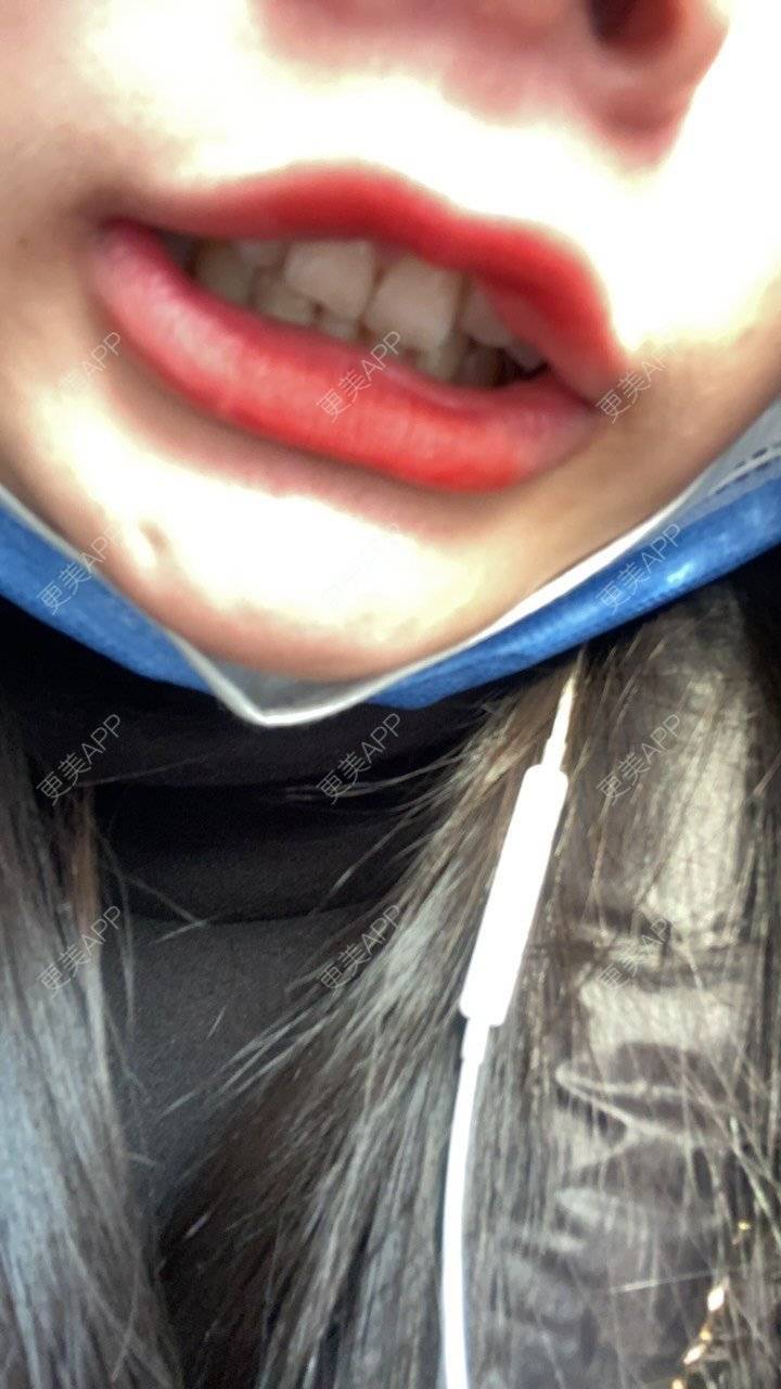 更美 - 更美的小沁沁的皓齿美白经验 | 皓齿美白 | 郑州