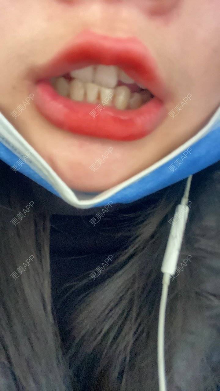 更美 - 更美的小沁沁的皓齿美白经验 | 皓齿美白 | 郑州