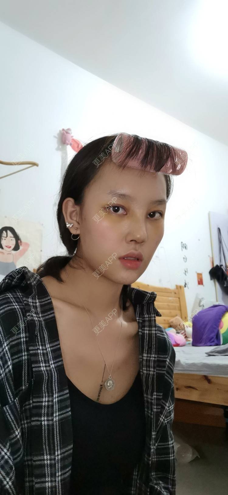 更美 - 更美用户P8Y9uWFdwL的肋软骨隆鼻经验 | 肋软骨隆鼻 | 绵阳