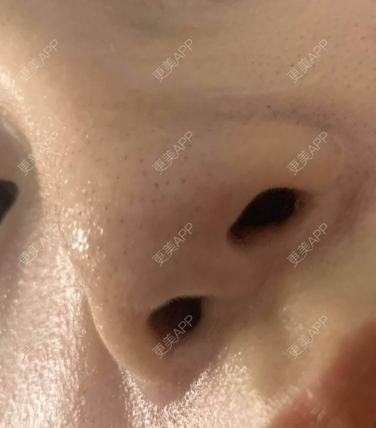 更美 - 圆方脸课代表ʚ😊ɞ的隆鼻经验 | 隆鼻 | 假体垫鼻基底 | 鼻部多项 | 硅胶隆鼻 | 全切双眼皮 | 开内眼角 | 自体软骨垫鼻尖 | 南京 | 耳软骨隆鼻 | 视频日记