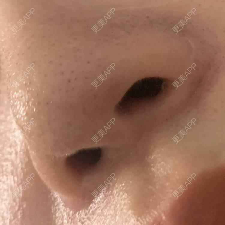 更美 - 圆方脸课代表ʚ😊ɞ的隆鼻经验 | 隆鼻 | 假体垫鼻基底 | 鼻部多项 | 硅胶隆鼻 | 全切双眼皮 | 开内眼角 | 自体软骨垫鼻尖 | 南京 | 耳软骨隆鼻 | 视频日记