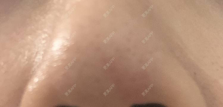更美 - 圆方脸课代表ʚ😊ɞ的隆鼻经验 | 隆鼻 | 假体垫鼻基底 | 鼻部多项 | 硅胶隆鼻 | 全切双眼皮 | 开内眼角 | 自体软骨垫鼻尖 | 南京 | 耳软骨隆鼻 | 视频日记