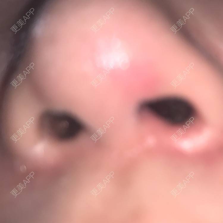 更美 - 圆方脸课代表ʚ😊ɞ的隆鼻经验 | 隆鼻 | 假体垫鼻基底 | 鼻部多项 | 硅胶隆鼻 | 全切双眼皮 | 开内眼角 | 自体软骨垫鼻尖 | 南京 | 耳软骨隆鼻 | 视频日记