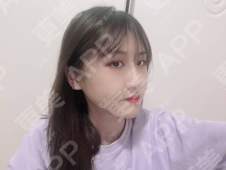 更美 - 更美用户taFzgika2u的下颌角经验 | 下颌角 | 颧骨内推 | 武汉