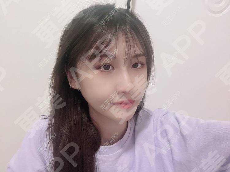 更美 - 更美用户taFzgika2u的下颌角经验 | 下颌角 | 颧骨内推 | 武汉