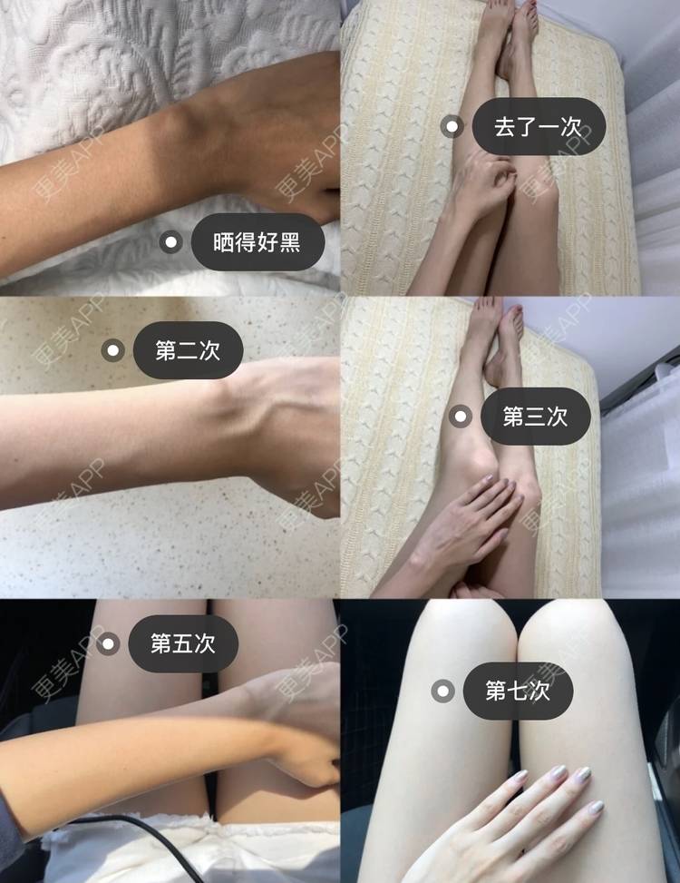 更美 - 更美用户2jPb1EBm5p的彩光嫩肤经验 | 彩光嫩肤