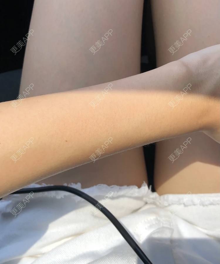 更美 - 更美用户2jPb1EBm5p的彩光嫩肤经验 | 彩光嫩肤
