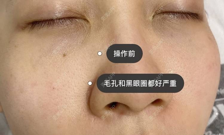 更美 - 更美用户iKgVoOKIfD的彩光嫩肤经验 | 彩光嫩肤