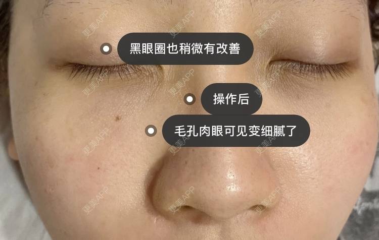 更美 - 更美用户iKgVoOKIfD的彩光嫩肤经验 | 彩光嫩肤