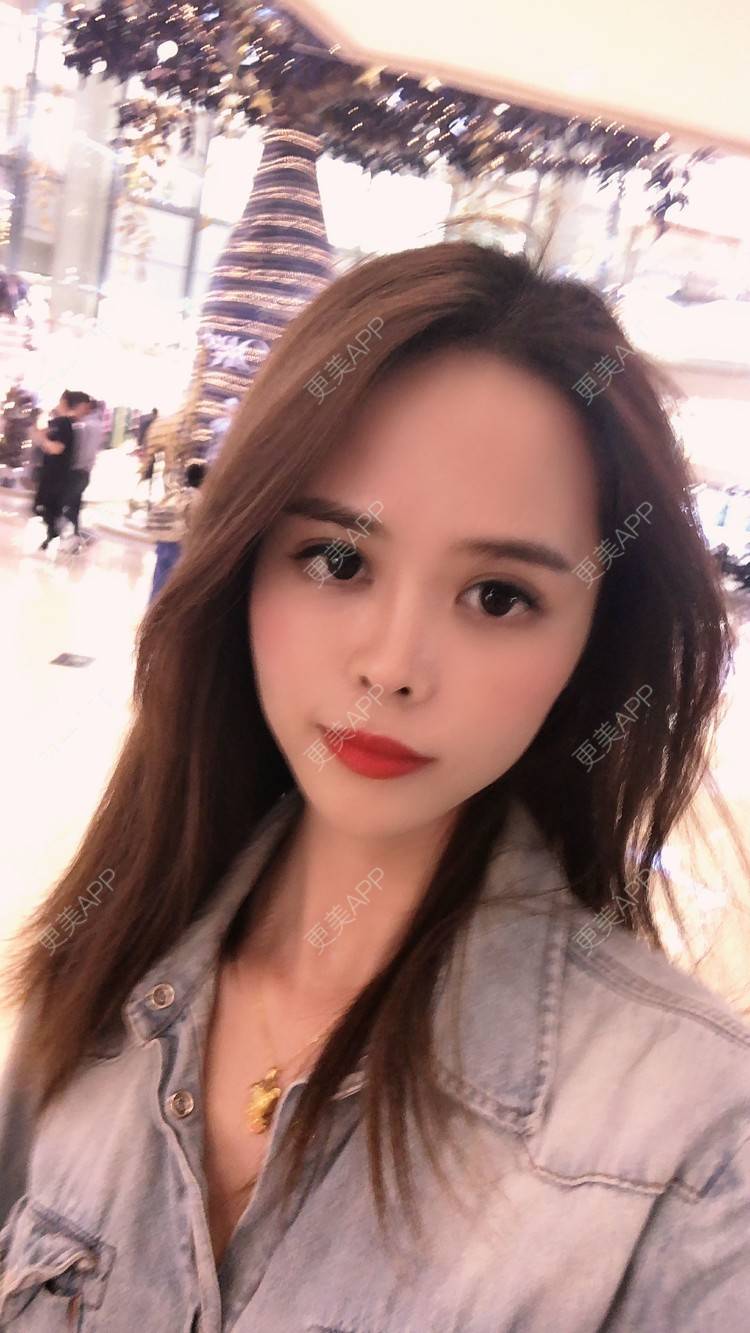更美 - 更美用户M7EvKAD66P的玻尿酸经验 | 玻尿酸面部细纹 | 玻尿酸泪沟 | 玻尿酸 | 深圳