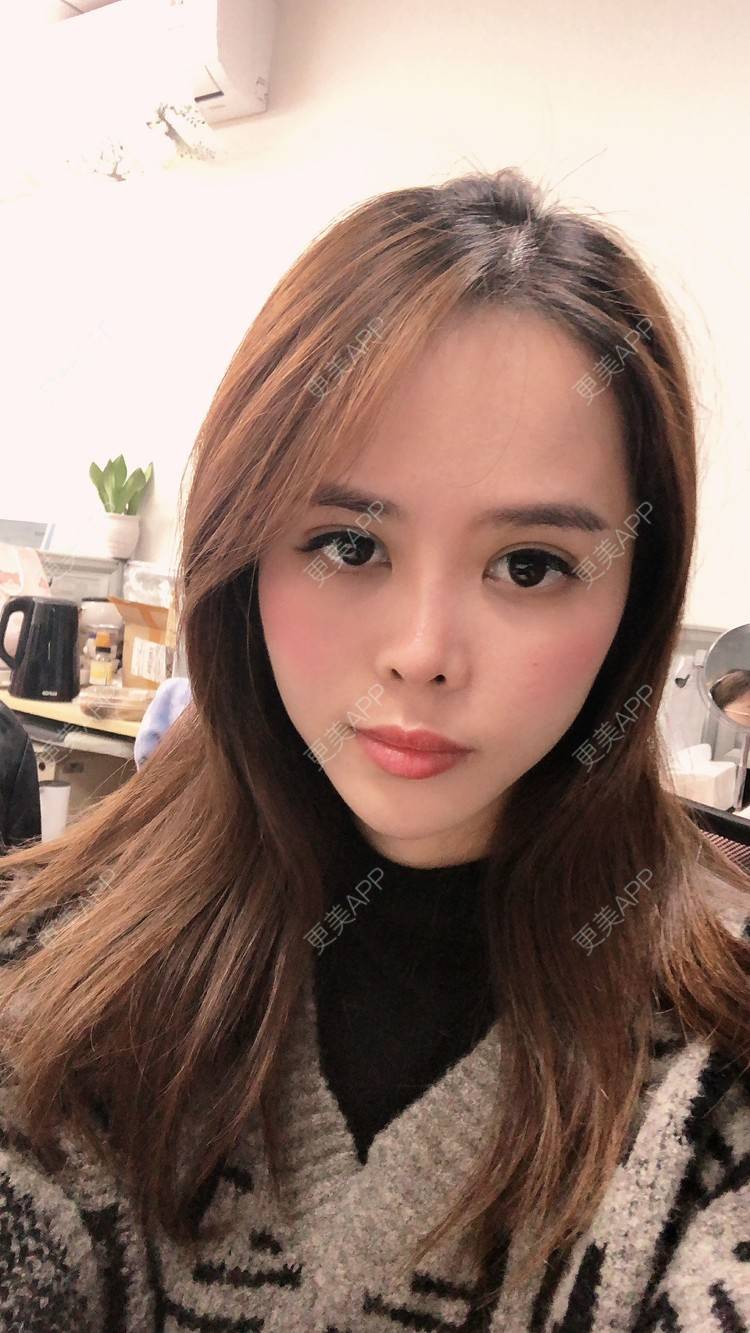 更美 - 更美用户M7EvKAD66P的玻尿酸经验 | 玻尿酸黑眼圈 | 玻尿酸面颊 | 玻尿酸 | 深圳